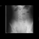 Ileus, small bowel obstruction: X-ray - Plain radiograph